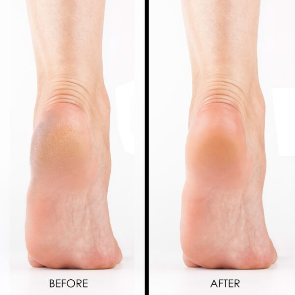 Before and After Callus Remover